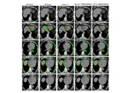 Uncertainty Driven Bottleneck Attention U-Net for Organ at Risk Segmentation